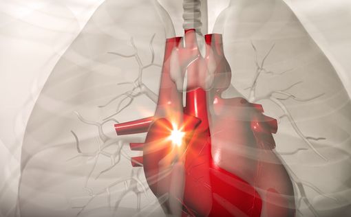 Доклад: риск сердечного приступа можно снизить без операции