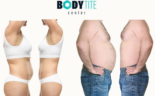 Body Tite: липосакция, подтяжка кожи, омоложение лица