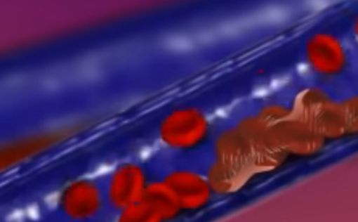 Как образуются сгустки крови, убивающие больных COVID