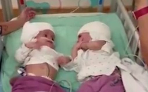 Видео: разделенные близнецы впервые увидели друг друга после операции