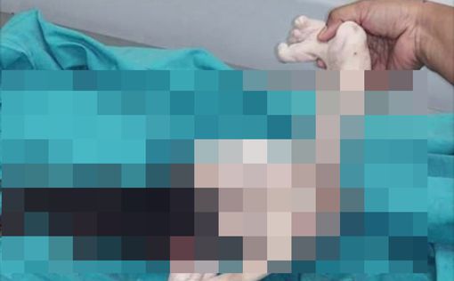 Подросток 15 лет жил с нерожденным близнецом в желудке