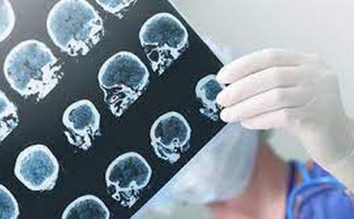 Симптомы, которые свидетельствуют о ранних признаках болезни Альцгеймера