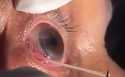 Видео: из глаза достают 15-сантиметрового паразита