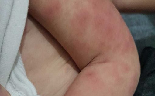 У 4-летней девочки странная сыпь оказалась симптомом COVID | Фото: AFP