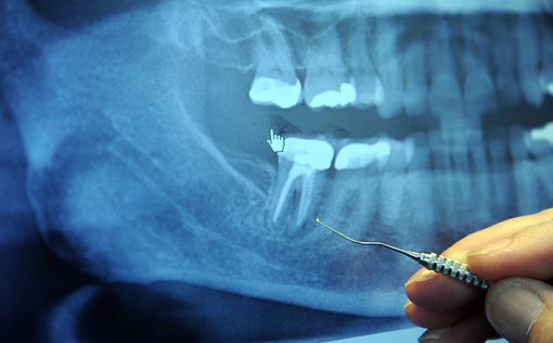 Ученые: потеря зубов влияет на память