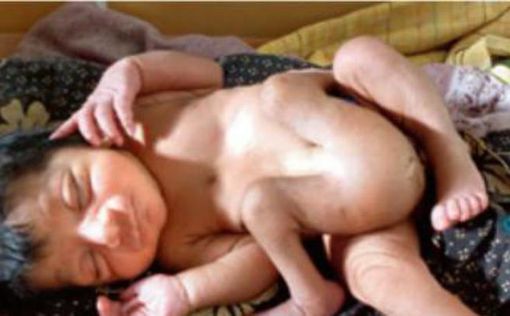 В Индии родился ребенок с шестью конечностями