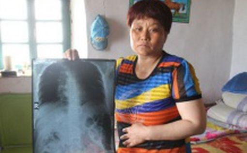 Китаянка прожила 10 лет с иглами в теле
